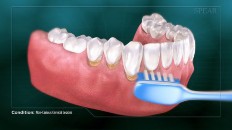 teeth being brushed with a blue tooth brush