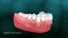 teeth with extreme plaque by the gumline