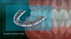 closeup of a occlusal appliance