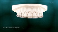 a white teeth diagram with the occlusal appliance
