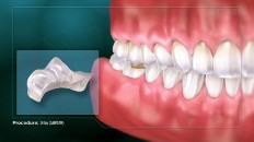 an onlay next to a set of teeth