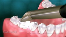 a handheld scanner is scanning a tooth