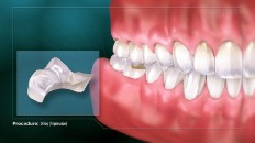 close up of teeth onlay