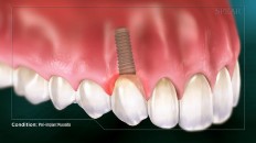 teeth with inflamed tissue