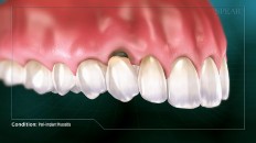 teeth with plaque and bone loss
