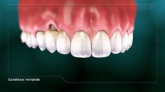 teeth with receding gums