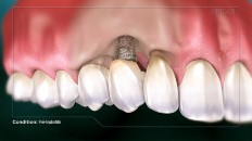 a cross section of teeth and gums with bacteria