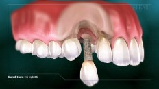 an implant that can't stay in the gums