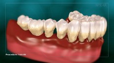 teeth with extreme gum loss