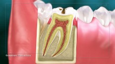 crosscut of a tooth with decay