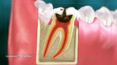 crosscut of a tooth with inflamed roots