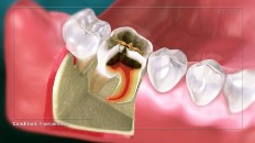 crosscut of a tooth with extreme decay