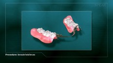 two removable dentures
