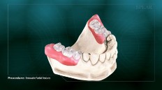 teeth impressions being made