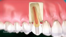 a tooth with an inflamed root