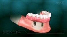 bottom set of dentures