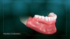 bottom set of dentures