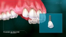 closeup of a tooth implant