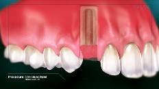 a place for a tooth implant it created