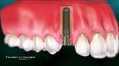 an implant is implanted