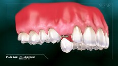 a temporary tooth being implanted