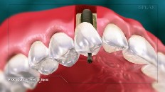 an implant being put into its space