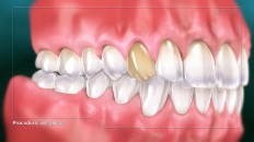 a set of teeth with a discolored tooth