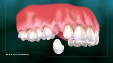 a temporary tooth being placed