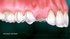 an area ready for a new tooth