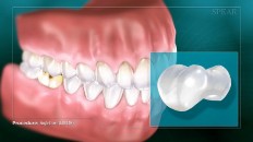 closeup of a tooth crown