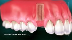 gums with space for an implant