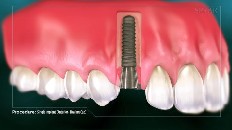 gums with an implant socket