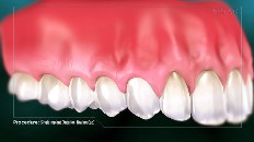 a top row of teeth with an implant