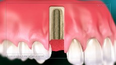 gums with an implant socket