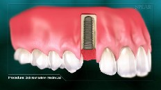 an implant socket being prepared