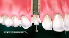 a new tooth in a socket