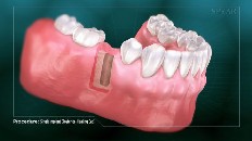 gums with an empty place for an implant