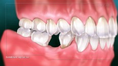 teeth with a bottom one missing