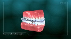 full set of teeth with mouth guard