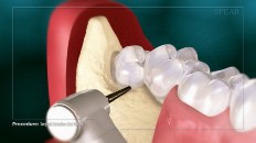 a tooth clearing space around the wisdom tooth