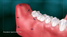 gums being sutured