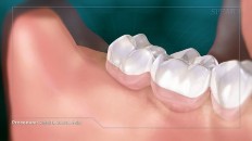 healthy gums with wisdom tooth extracted