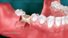 gums being pulled back from the decayed tooth