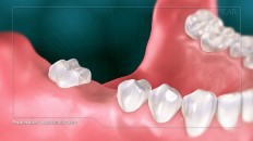 a set of teeth with healthy gums