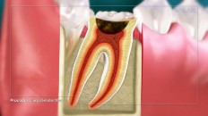 cross section of a tooth with inflamed gums