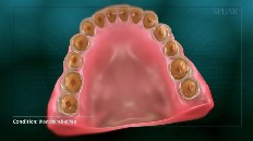 top down view of teeth worn down