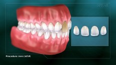 a set of teeth with veneer diagram