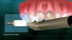 teeth being scanned