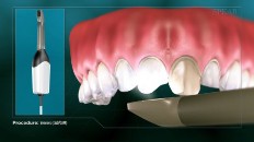 teeth getting filmed by a camera