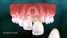 veneers being applied to front teeth